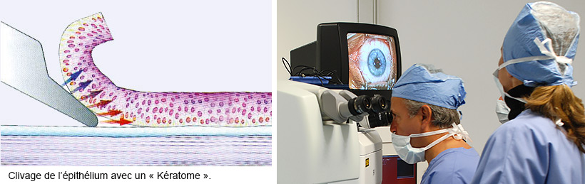 Clivage de l’épithélium avec un Kératome