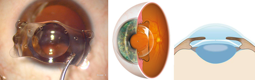 Implants rétractifs des yeux