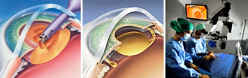 Implants rétractifs des yeux Prelex