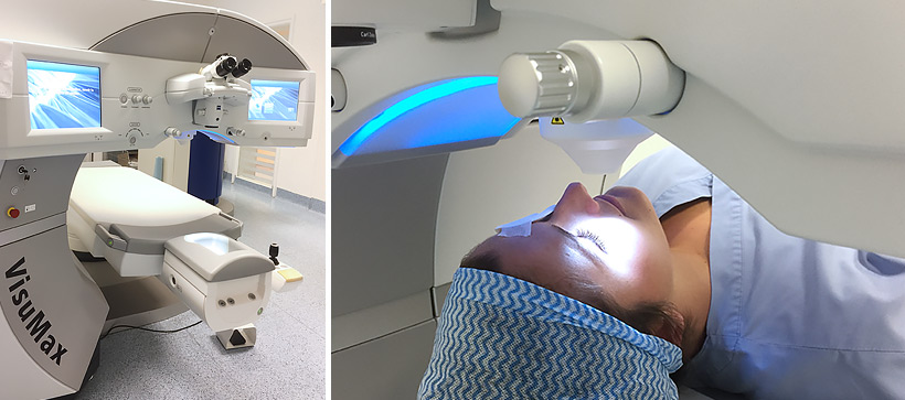 Le Smile technique d'opération des yeux avec le laser femtoseconde Visumax