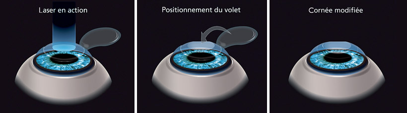 Schéma opération Lasik